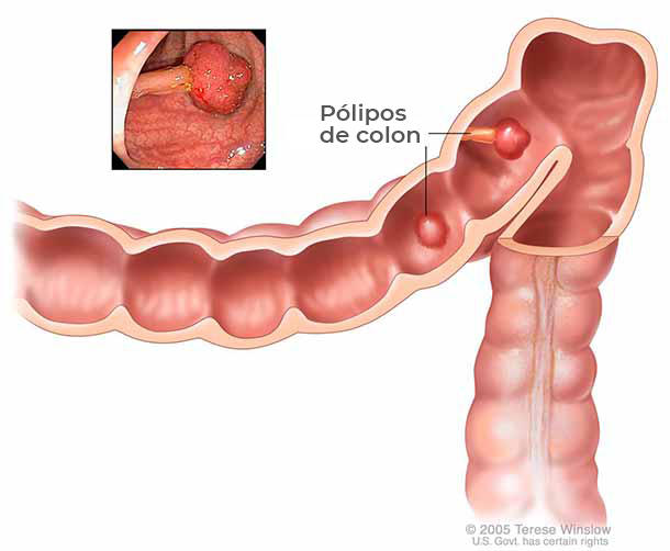 colonoscopia con pólipos